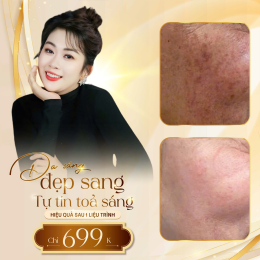 Điều Trị Nám