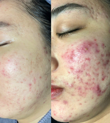 DỊCH VỤ TRỊ MỤN CHUYÊN SÂU
