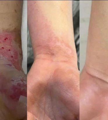 XOÁ SẸO BẰNG CÔNG NGHỆ COLD PLASMA
